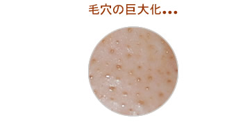 毛穴の巨大化